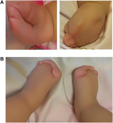 Apert Syndrome With FGFR2 758 C > G Mutation: A Chinese Case Report